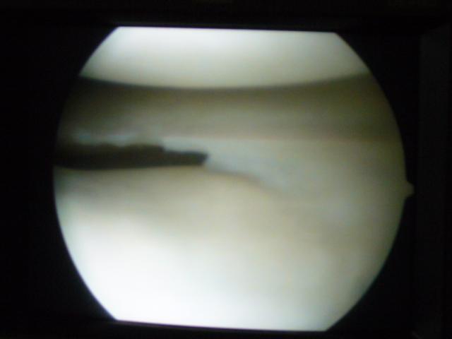 Travel - Bolivia - Knee Operation